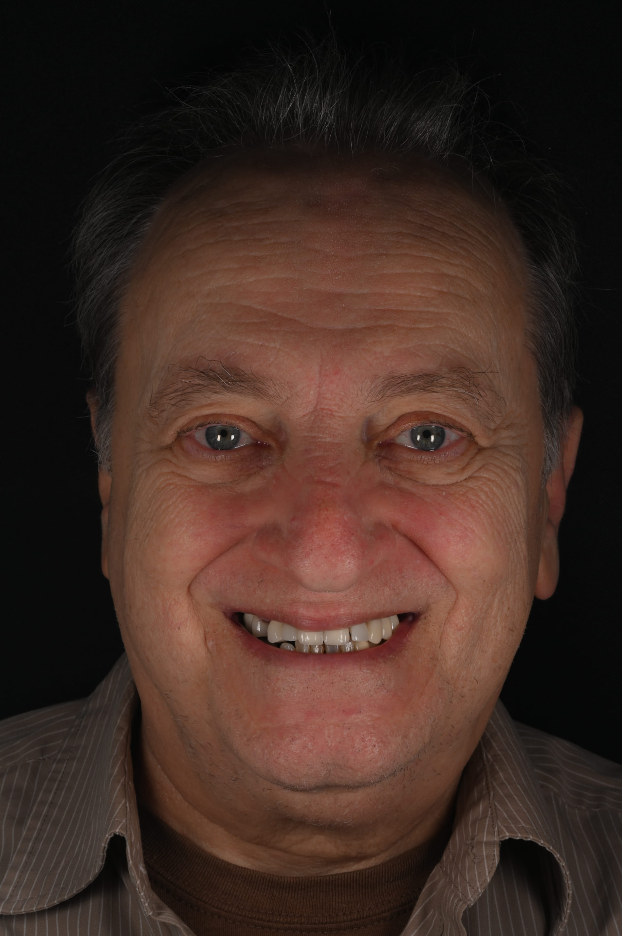 Before — Full upper & lower restoration — a whole new smile