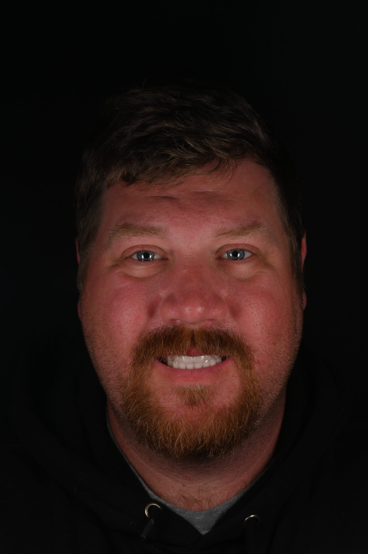 After — Missing teeth replaced — a strong, confident smile
