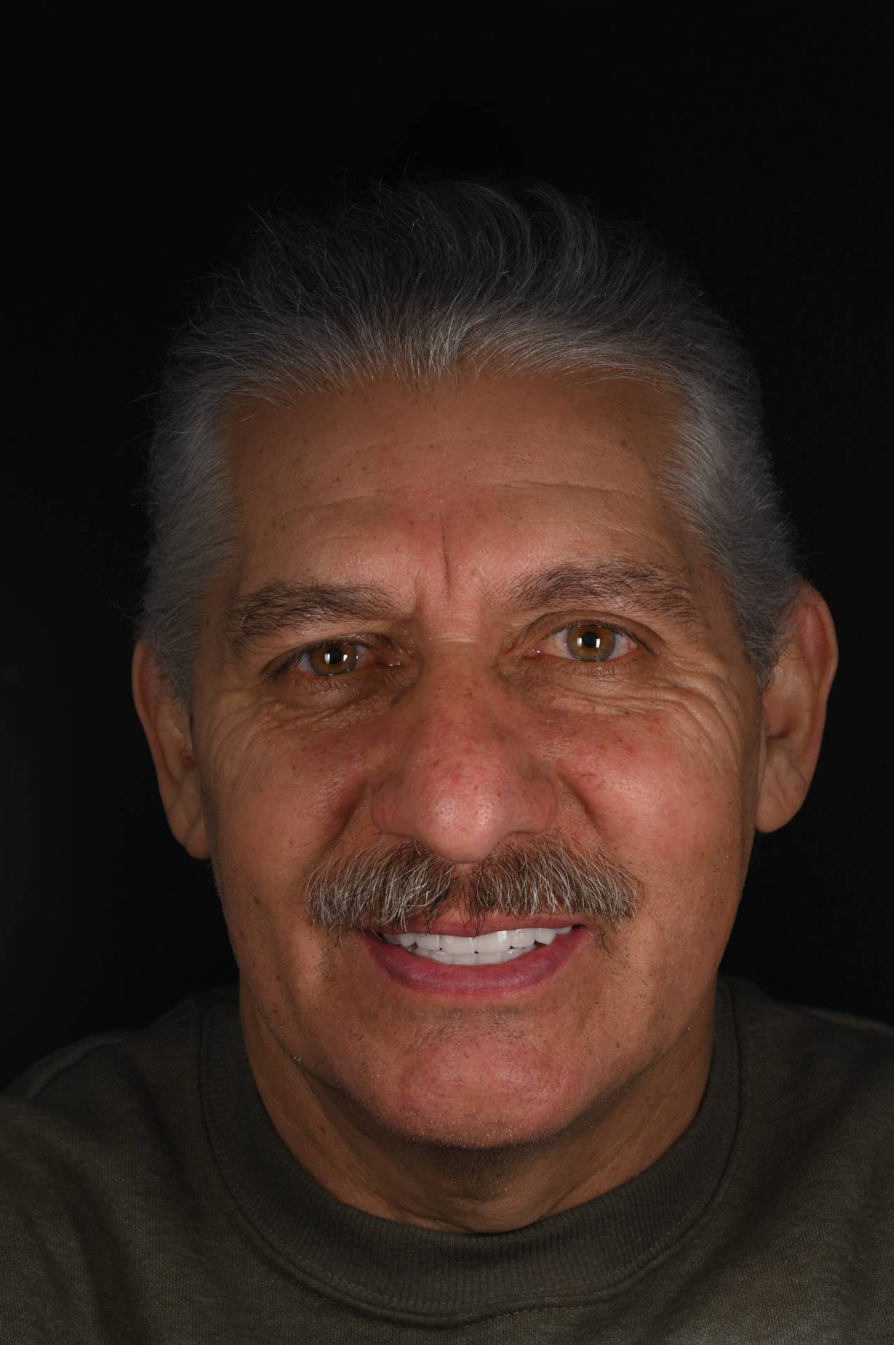 After — Failing teeth to a brand-new smile