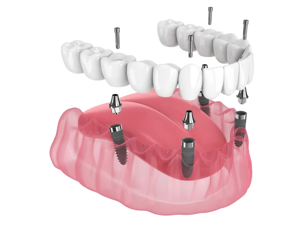 Full-Arch Dental Implants
