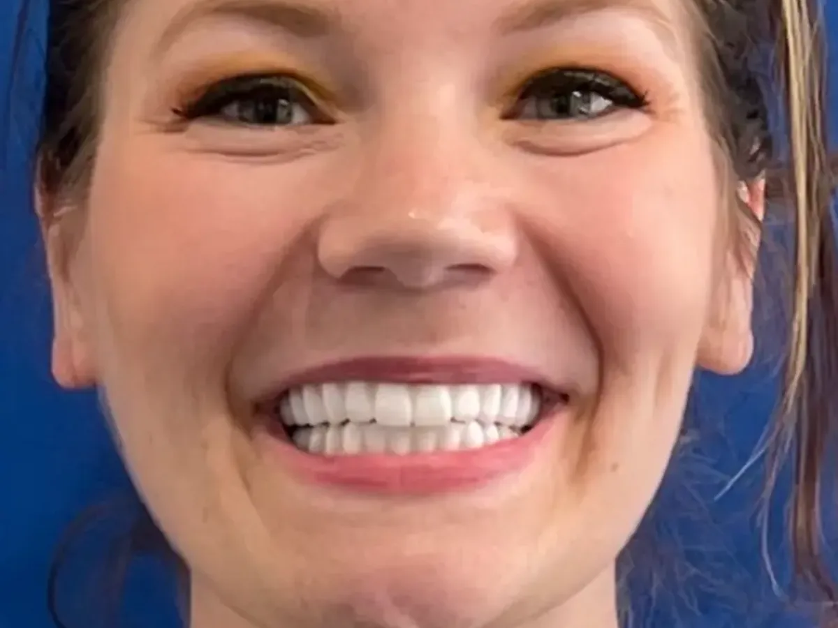 After — Missing teeth replaced — a strong, confident smile