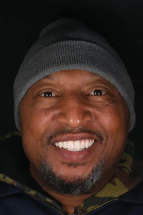 After — Worn, shifting teeth rebuilt — bright, even smile