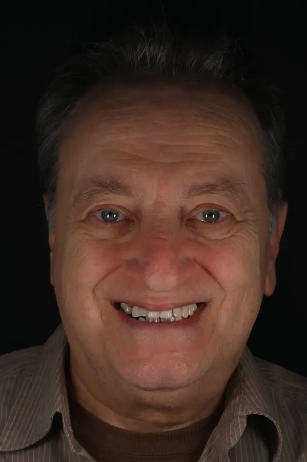 Before — Full upper & lower restoration — a whole new smile