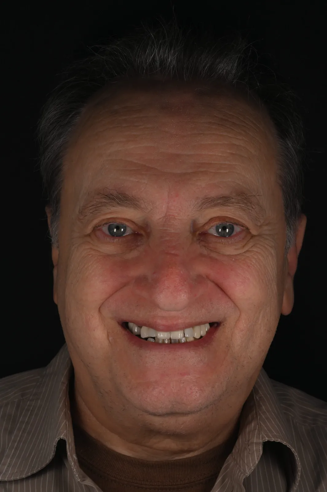 Before — Full upper & lower restoration — a whole new smile